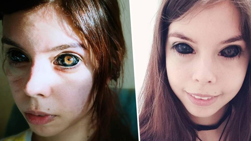 ଆଖିରେ ଟାଟୁ କରିବା ହେଲା କାଳ, ଚାଲିଗଲା ଦୃଷ୍ଟିଶକ୍ତି 