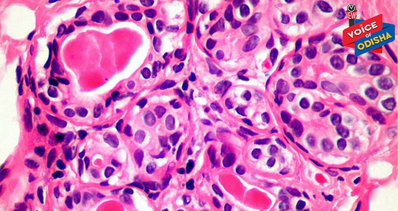 ପାଞ୍ଚ ବର୍ଷରେ କର୍କଟ ରୋଗୀ, ସଂଖ୍ୟା ୨ ଲକ୍ଷ ବଢ଼ିଯିବ