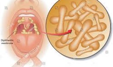 ଡିପ୍‌ଥେରିଆ ରୋଗ  କଣ? ଏହାର କାରଣ ଓ ସଂକେତ